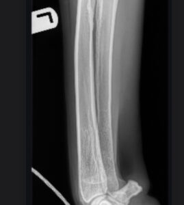 This XRay of Tucker’s left fron tleg shows the nromal look of the bone when there is no problem.