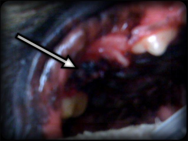 Absorbable stitches at the gingival flap site of the fourth premolar exodontia