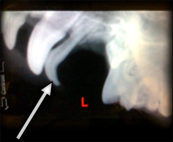 x-ray of retained deciduous canine tooth x-ray of retained deciduous canine tooth