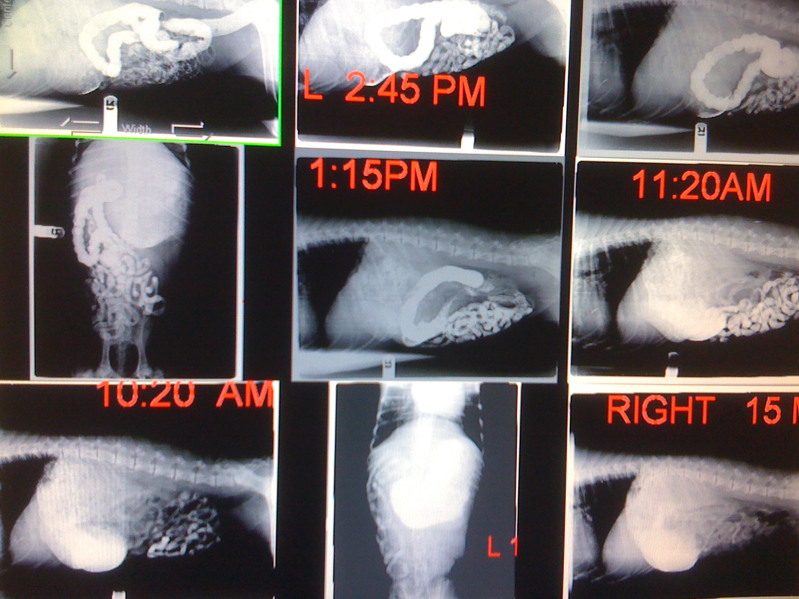 a series of x-rays showing the progression of the white liquid metal barium from the stomach, snaking through 30 plus feet of coiled intestines, and straight out the descending colon